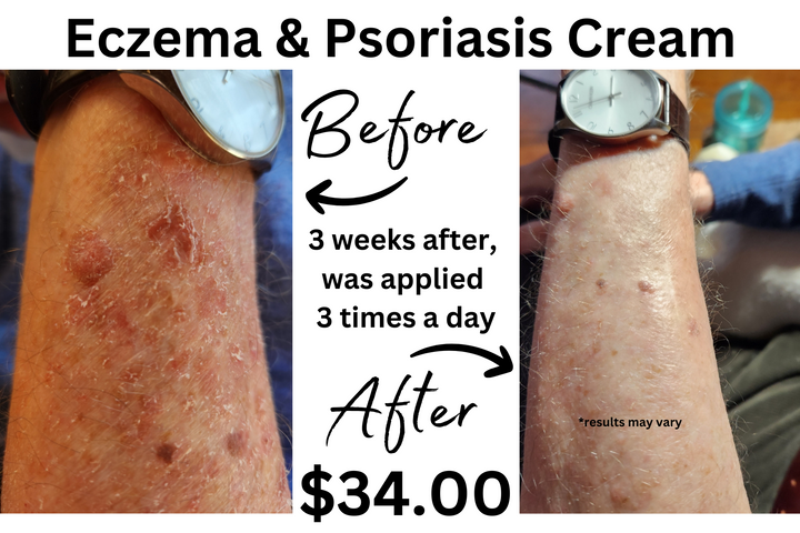 Eczema & Psoriasis Cream
